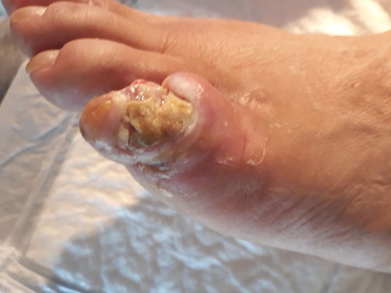 before-diavitiko-elkos-me-osteomyelitida