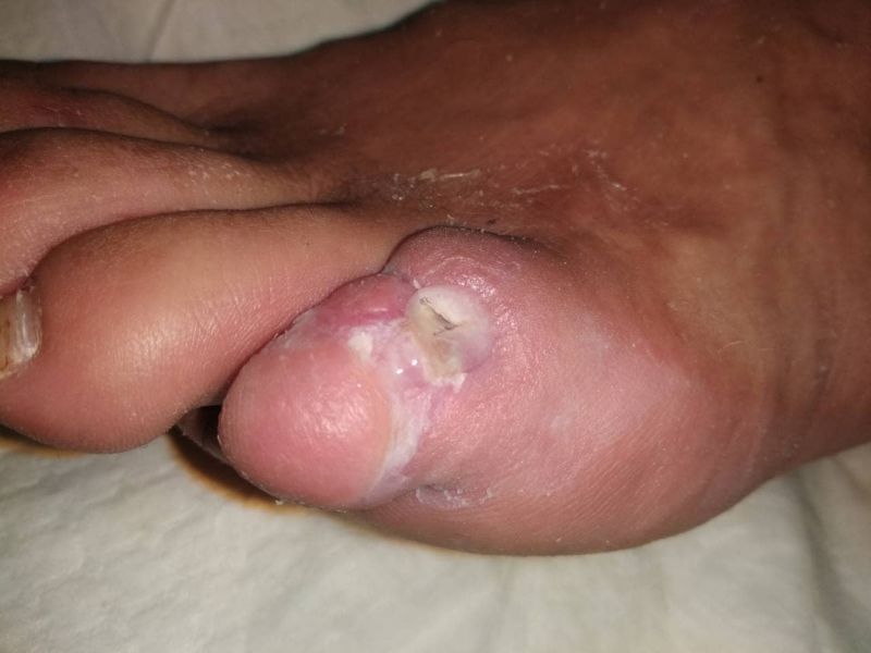 before-diavitiko-elkos-me-osteomyelitida