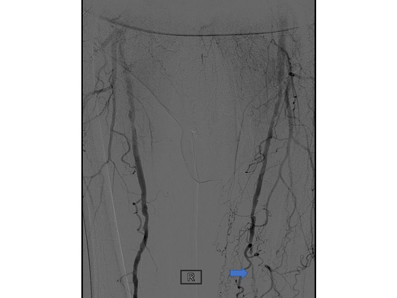 athina-kapraloy-aggeioplastiki-me-topothetisi-stent