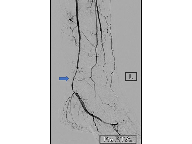 before-athina-kapraloy-dianoixi-aggeioy-diabitikoy-podioy-me-mpaloni-pixelation