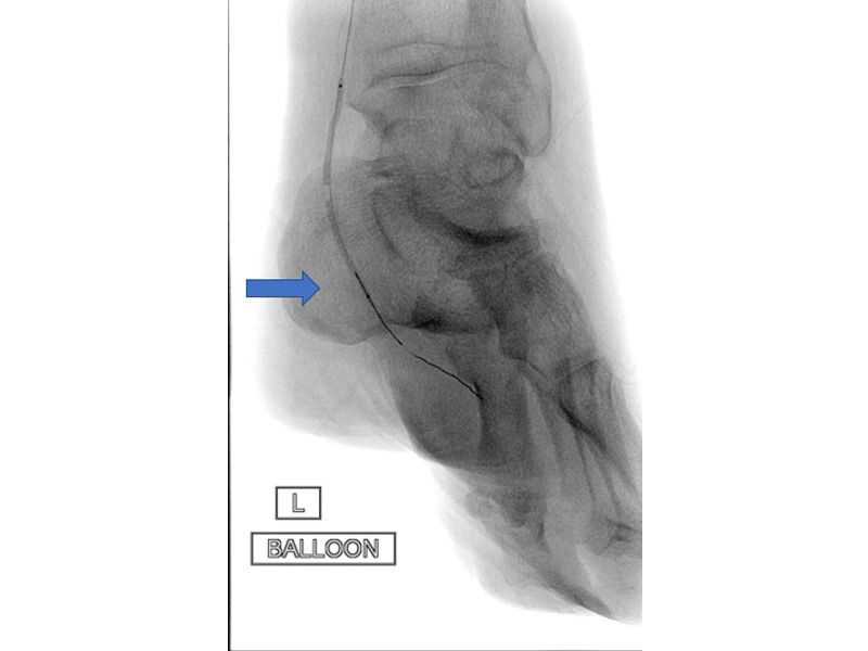 before-athina-kapraloy-dianoixi-aggeioy-diabitikoy-podioy-me-mpaloni-pixelation