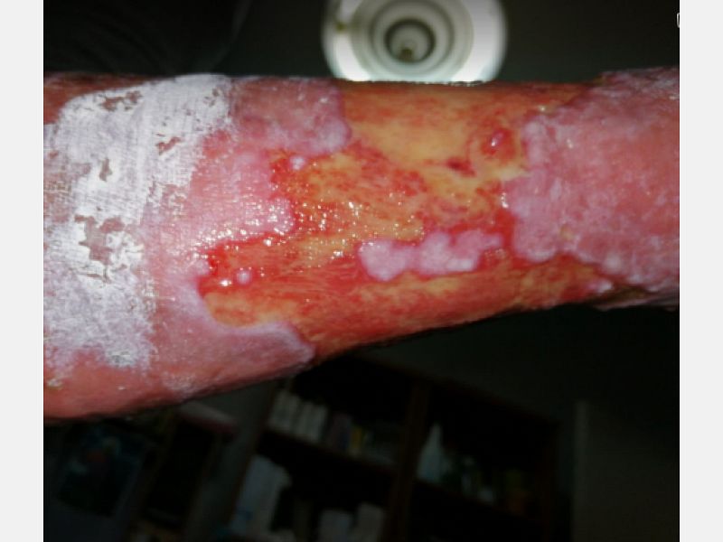 athina-kapraloy-ektetamena-elki-se-diabitiko-astheni