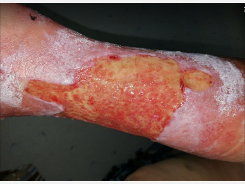 athina-kapraloy-ektetamena-elki-se-diabitiko-astheni