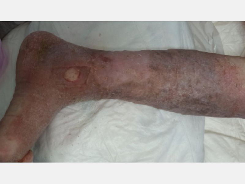 athina-kapraloy-ektetamena-elki-se-diabitiko-astheni