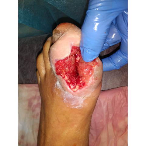 osteomyelitida-sto-megalo-daktylo-diabitikoy-podioy