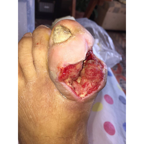 osteomyelitida-sto-megalo-daktylo-diabitikoy-podioy