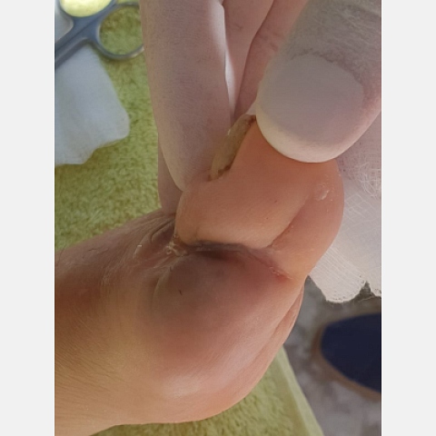 osteomyelitida-sto-megalo-daktylo-diabitikoy-podioy