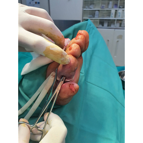 athina-kapraloy-osteomyelitida-sto-4o-daktylo-diabitikoy-podioy