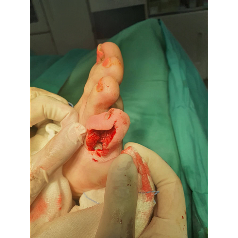 athina-kapraloy-osteomyelitida-sto-4o-daktylo-diabitikoy-podioy