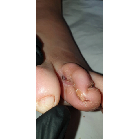 athina-kapraloy-osteomyelitida-sto-4o-daktylo-diabitikoy-podioy