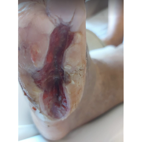 osteomyelitida-sto-5o-daktylo-diabitikoy-podioy