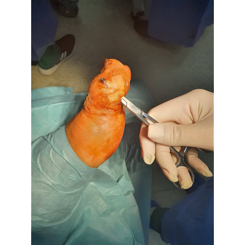 athina-kapraloy-osteomyelitida-sto-megalo-daktylo-diabitikoy-podioy