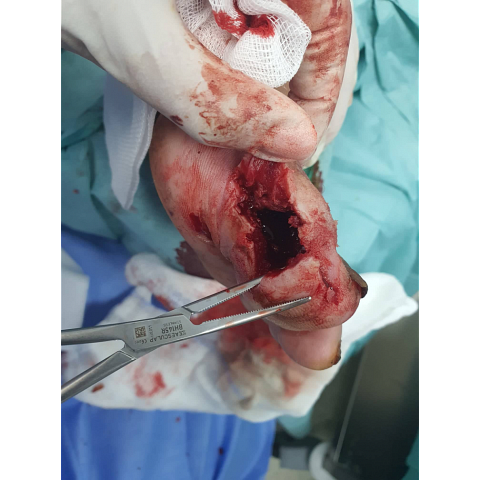 athina-kapraloy-osteomyelitida-sto-megalo-daktylo-diabitikoy-podioy