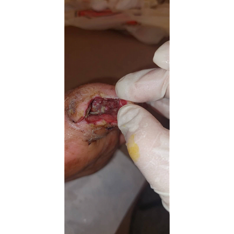 athina-kapraloy-osteomyelitida-sto-megalo-daktylo-diabitikoy-podioy