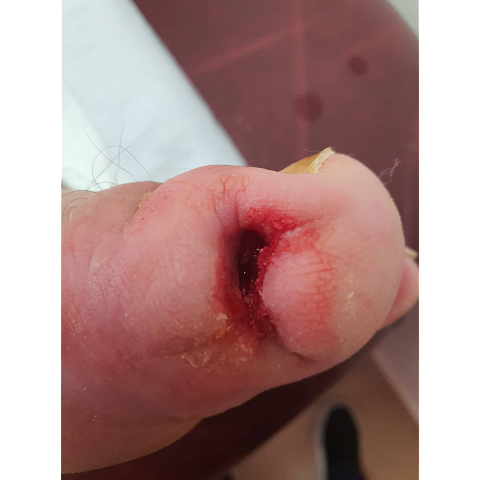 athina-kapraloy-osteomyelitida-sto-megalo-daktylo-diabitikoy-podioy