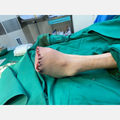 athina-kapraloy-gaggraina-daktylon-se-diabitiko-podi