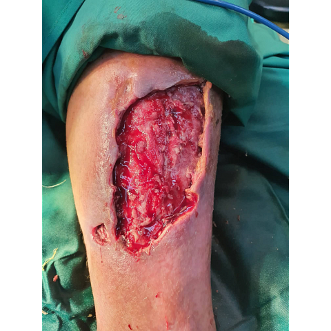 ektetamena-elki-knimis-se-diabitiko-podi