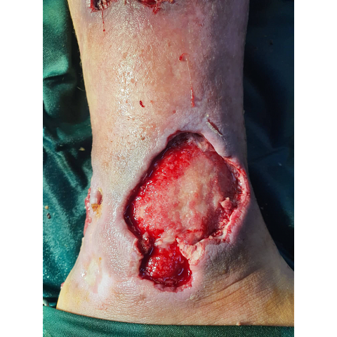 ektetamena-elki-knimis-se-diabitiko-podi