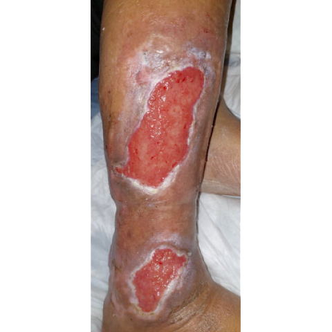 ektetamena-elki-knimis-se-diabitiko-podi