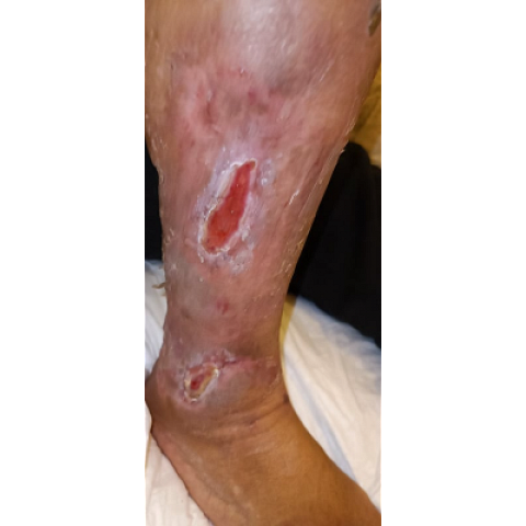 ektetamena-elki-knimis-se-diabitiko-podi