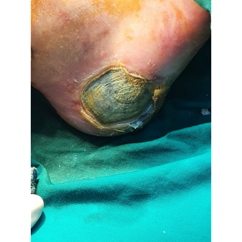 athina-kapraloy-nekrosi-stin-exo-epifaneia-diabitikoy-podioy