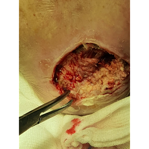 athina-kapraloy-nekrosi-stin-exo-epifaneia-diabitikoy-podioy