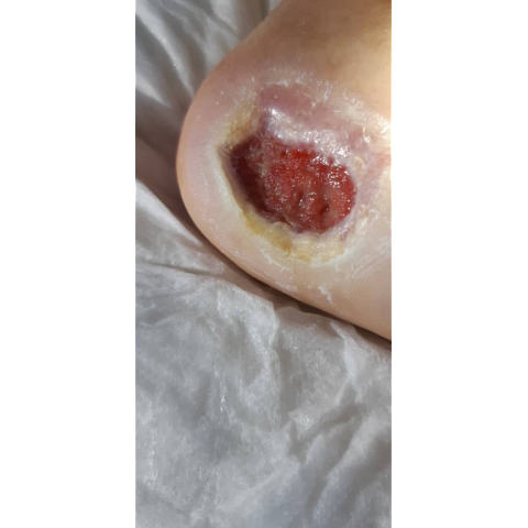 athina-kapraloy-nekrosi-stin-exo-epifaneia-diabitikoy-podioy