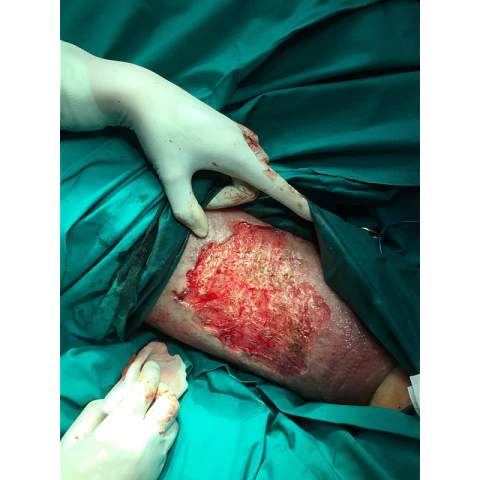 athina-kapraloy-ektetameno-elkos-knimis-se-diabitiko-podi