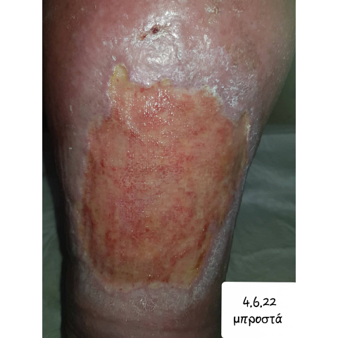 athina-kapraloy-ektetameno-elkos-knimis-se-diabitiko-podi