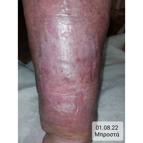 athina-kapraloy-ektetameno-elkos-knimis-se-diabitiko-podi