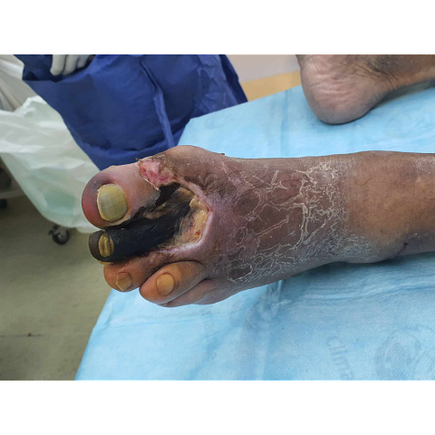 gaggraina-daktylon-se-diabitiko-podi