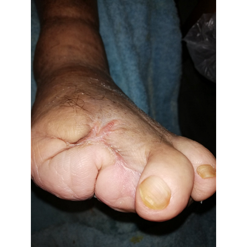 gaggraina-daktylon-se-diabitiko-podi